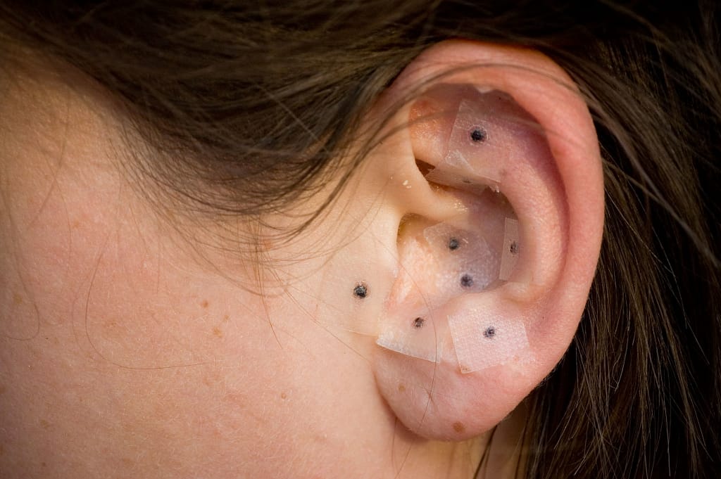 Auriculoterapia